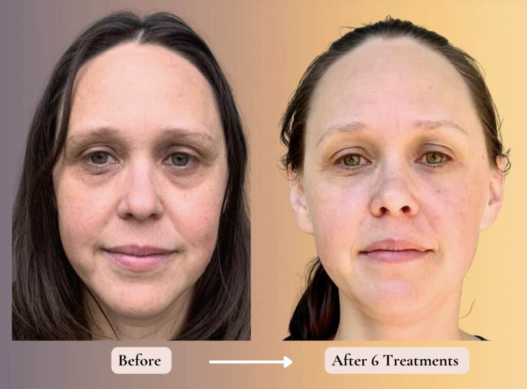 before and after 6 tx